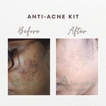 Anti-Acne Serum Gel