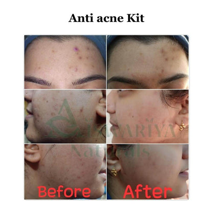 Anti-Acne Serum Gel