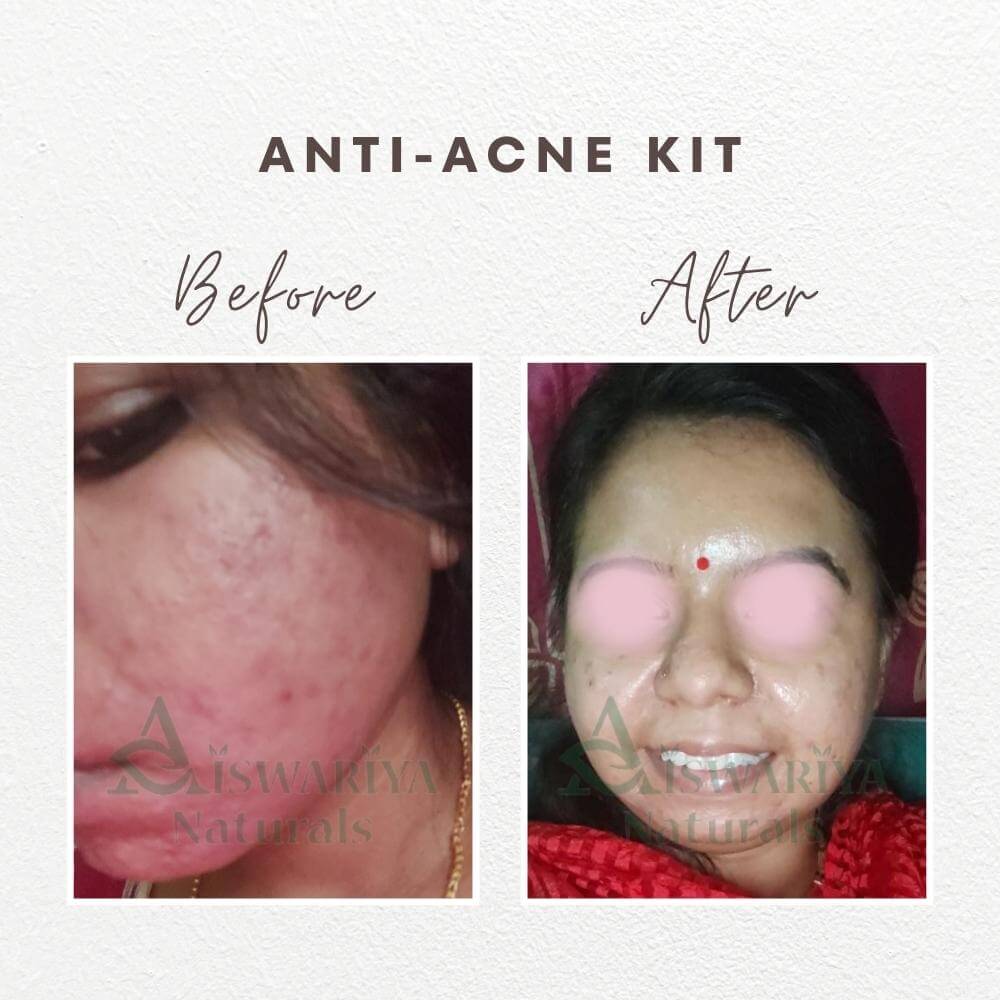 Anti-Acne Serum Gel