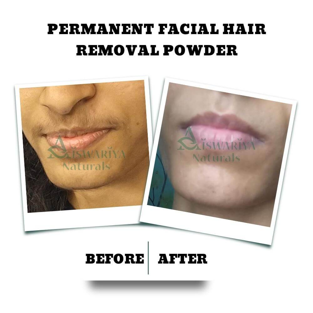 Permanent Facial Hair Removal