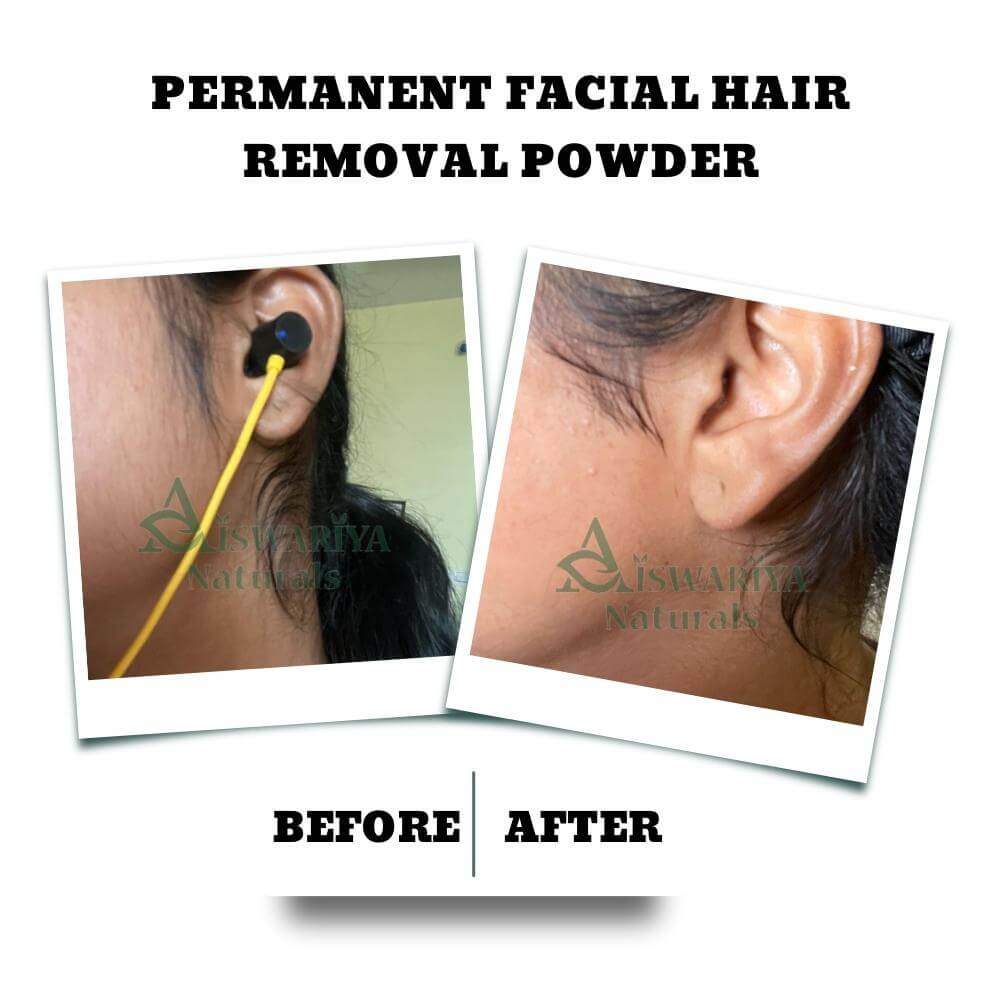 Permanent Facial Hair Removal