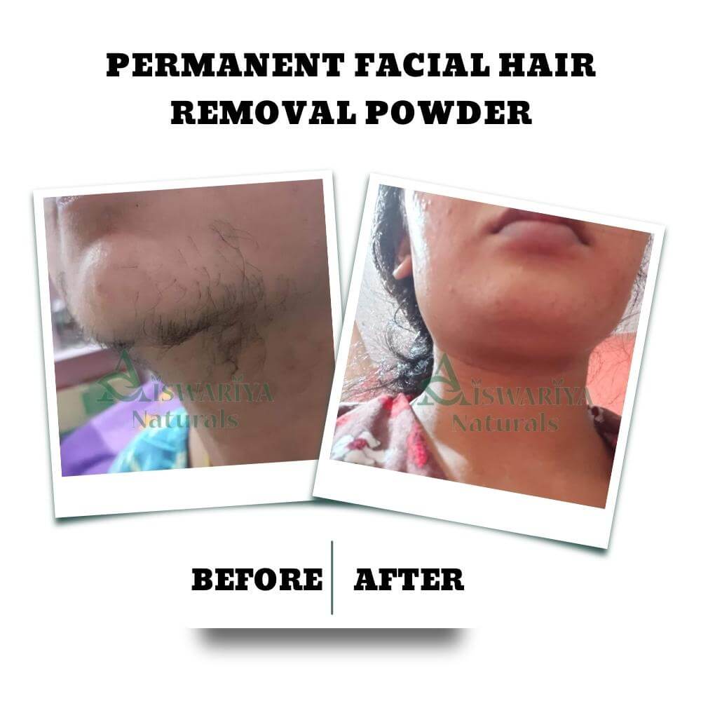 Permanent Facial Hair Removal